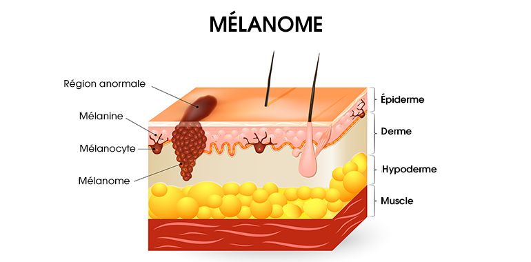 apparition-du-melanome